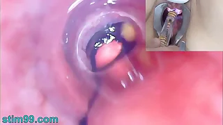 Mature Tolerant Peehole Endoscope Camera relative to Bladder here Balls
